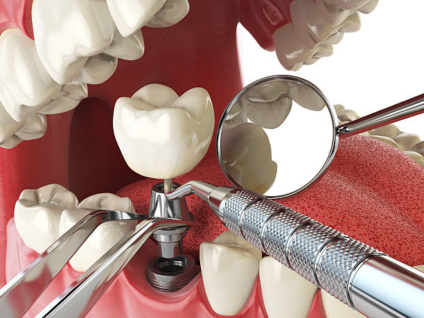 Best Emergency Dentist for Lost Fillings or Crowns in Arizona City, AZ